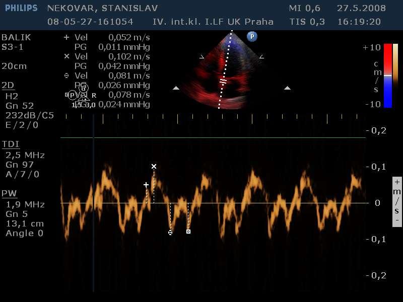 E/E >13 elevated LVEDP