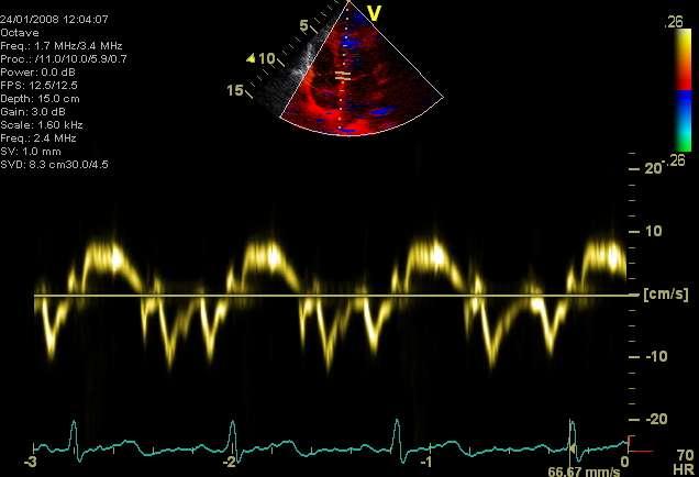 Sepsis induced changes of diastolic function: