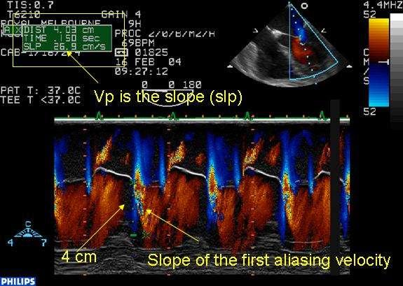 Reversible impairment in 20% Associated with levels of