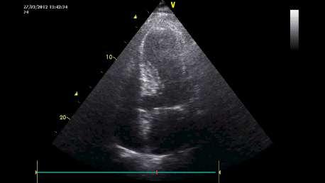ESLV axis úhel k LVOT > 60 Prominentní papilární sval