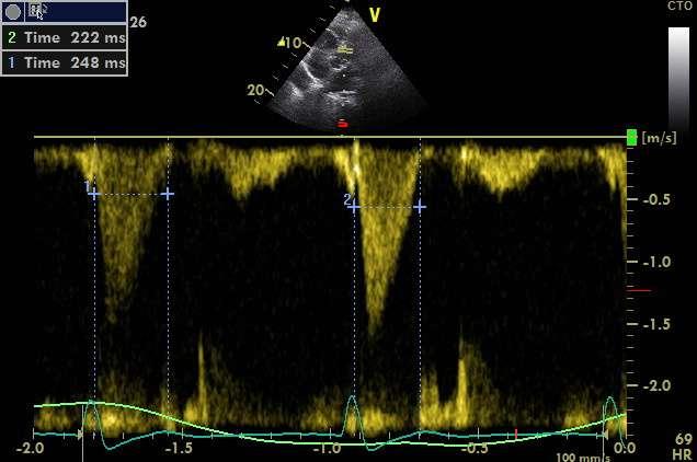 Tei index LV/RV Isovolemic
