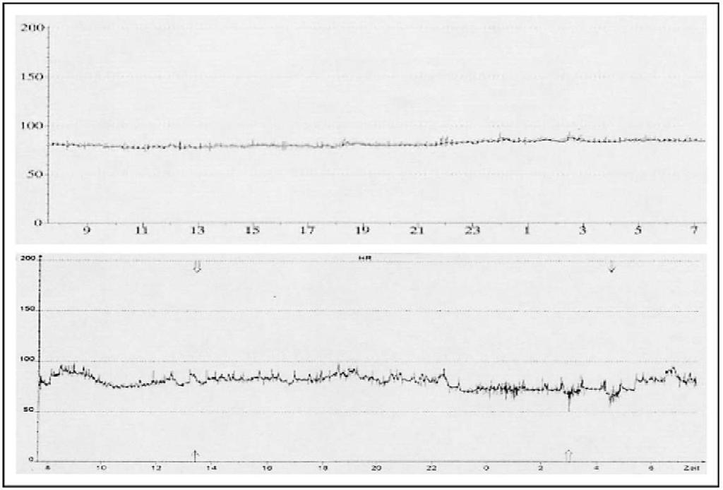 Low HR variability in sepsis (Schmidt H et al: Autonomic dysfunction in the