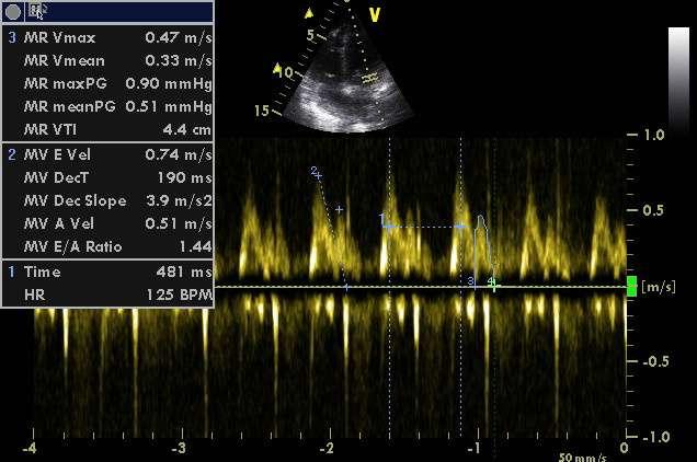 Betablocker and diastolic function in shock