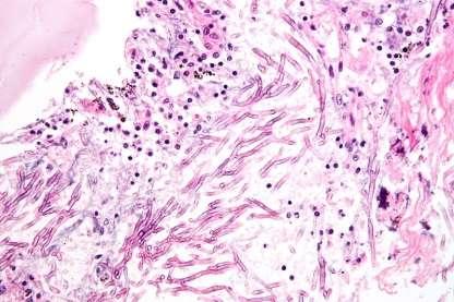 in imunocompromised 23 days after viremia Pneumococcus, Klebsiella,