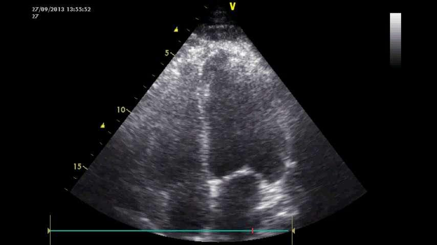 , Mycoplasma Risk of septic cardiomyopathy (incidence of 1560%;