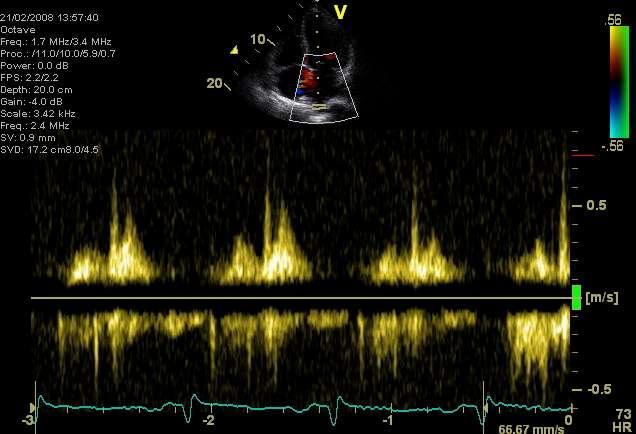prognosis of septic