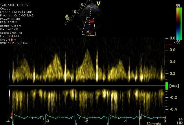 Transmitral PW combined