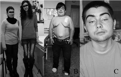 Homocystinurie Homocystinurie z deficitu cystathionin-β-syntázy je nejčastějším typem poruchy metabolismu methioninu.