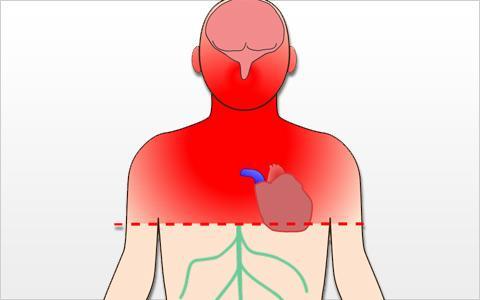 Autonomní dysreflexie reflexní nevyvážená