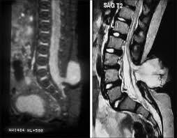 Dysrafismy obratlový oblouk neurální trubice spina bifida meningokéla meningomyelokéla meningomyelokéla (1/1000 narozených) 2% krční, 5% hrudní, 26% bederní, 20% sakrální a 47%