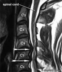 Herniace disku degenerativní - traumatická posterolaterální protruze kořen centrální protruze komprese L4-5, L5-S1 kořen - ztráta reflexů a čití perinea společně s radikulární iritací (S2-4, S1-2