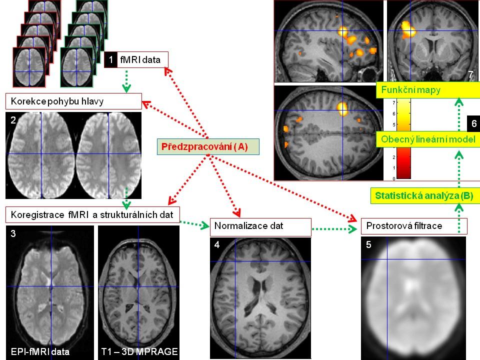 Obr. 3.4. Jednotlivé kroky předzpracování (A) fmri dat (1-6). (1) série naměřených funkčních dat, (2) korekce pohybových artefaktů a (3) koregistrace fmri a strukturálních dat s vysokým rozlišením.