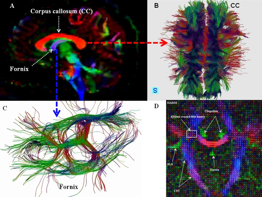 Obr. 3.9. Vizualizace svazků bílé hmoty v corpus callosum a fornix u 30letého dobrovolníka.