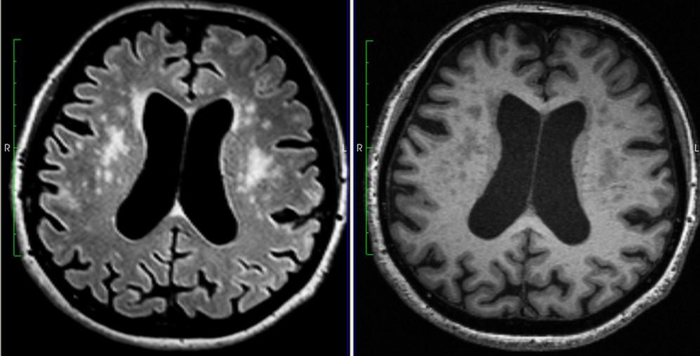 hmoty, corpus callosum (CC).