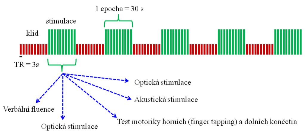 5.5. Uplatnění fmri u předoperačního vyšetření V rámci předoperačního vyšetření bylo od roku 2007 do současnosti provedeno vyšetření fmri a DTI na 3T tomografu Siemens Trio u několika desítek