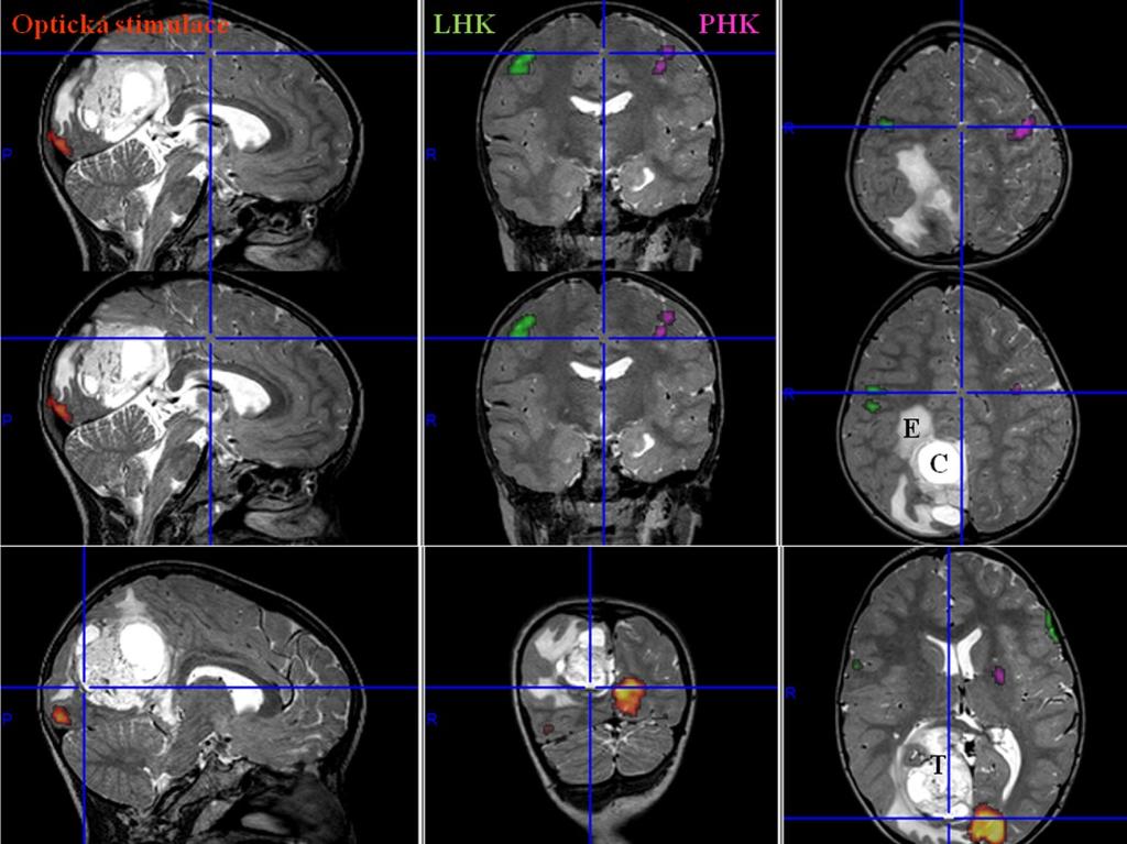 Zde uvádím čtyři příklady fmri a DTI a jejich využití v předoperačním vyšetření.