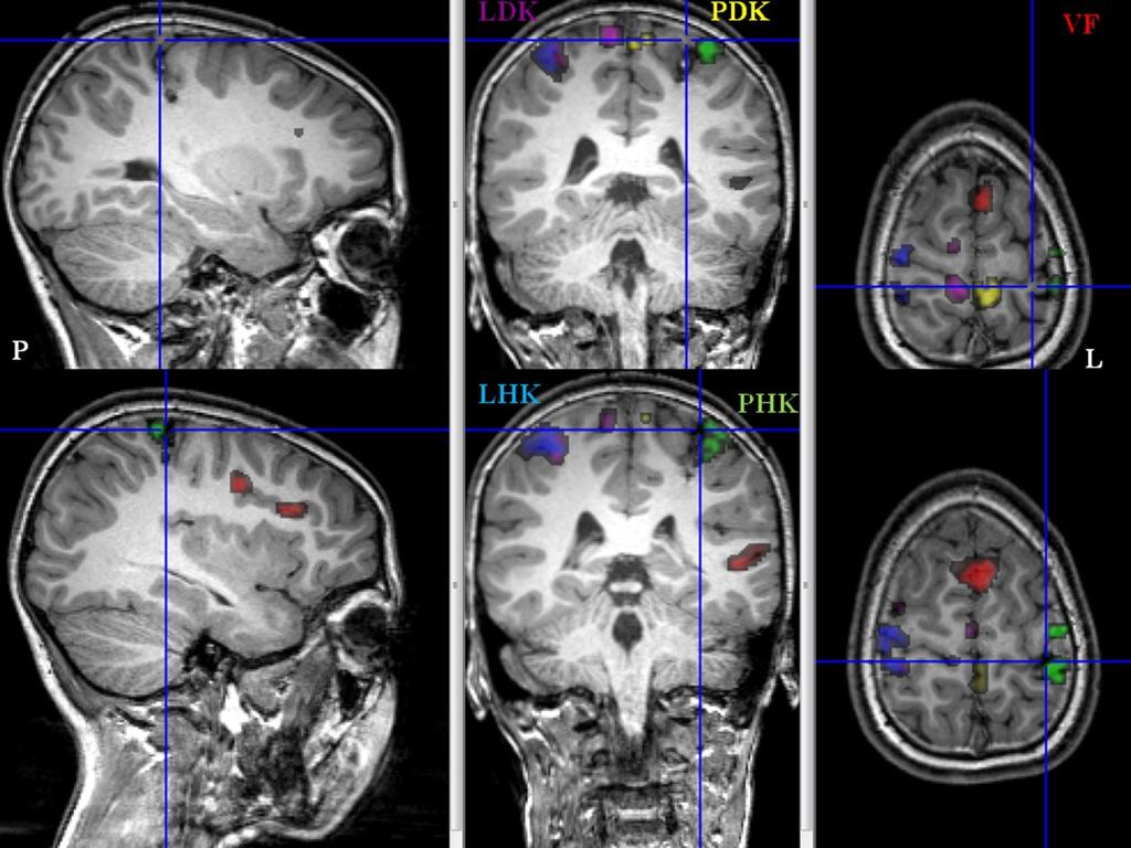 Příklad 2 Pacientka (11 roků) s kavernomy supratentoriálně parietálně vlevo a s parestezií pravostranných končetin byla vyšetřena na 3T tomografu s protokoly pro fmri, DTI, SWI a 3D MPRAGE.