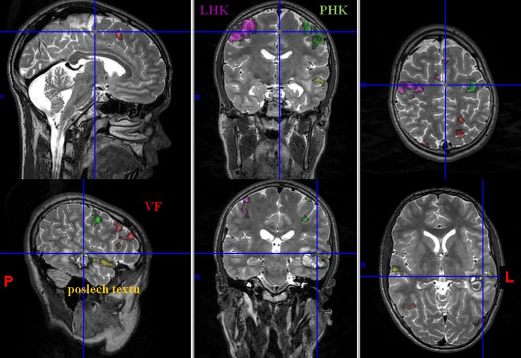 Příklad 3 Pacient (13 roků) s velkým kavernomem v temporální oblasti levé hemisféry byl vyšetřen standardním protokolem pro fmri, DTI, SWI a 3D T2 vážené morfologické zobrazování.