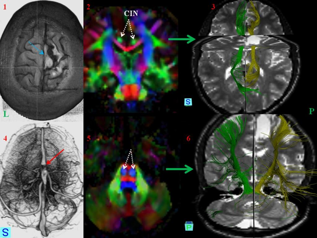 Příklad 4 Pacient (19 roků) po resekci meningeomu s recidivou v okraji resekční dutiny paramediálně frontálně vpravo byl s rozvojem sekundární epilepsie vyšetřen protokoly pro DTI a morfologické