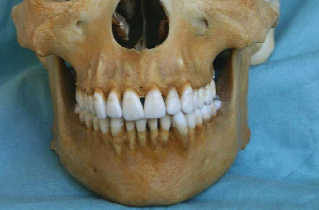 lebce glabella