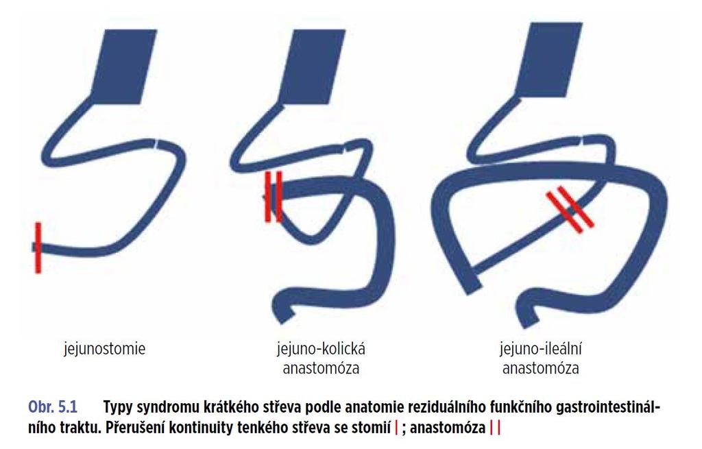 Syndrom krátkého střeva PATOFYZIOLOGICKÁ FUNKČNÍ