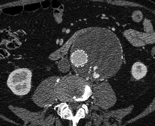 Obr. 1A Obr. 1. Endoleak II. typu, 69letý muž s endoleakem II. typu z aa. lumbales se zvětšujícím se vakem aneuryzmatu 10. rok po implantaci stentgraftu. A CT angiografie, endoleak II.