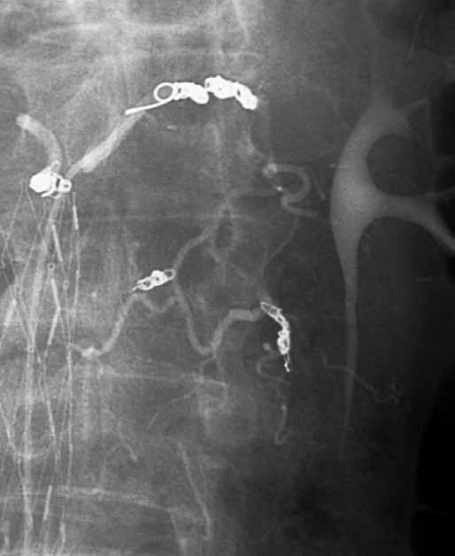 Endoleak type II, 68-years old man with endoleak type II from lumbar arteries with sac enlargement 10 years after stent-graft implantation.