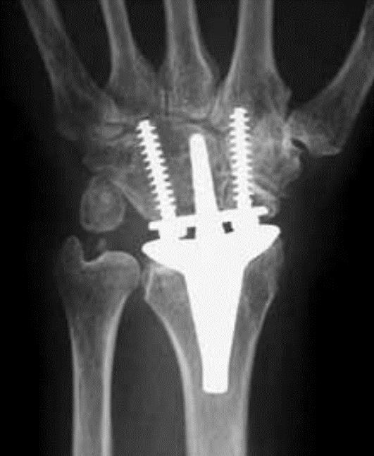 9 VÝPOČTOVÝ MODEL ZÁPĚSTÍ S TOTÁLNÍ NÁHRADOU Pro deformačně napěťovou analýzu zápěstí se zavedenou totální náhradou, byl vybrán implantát Re-Motion Total Wrist, jehož výrobcem je společnost Small