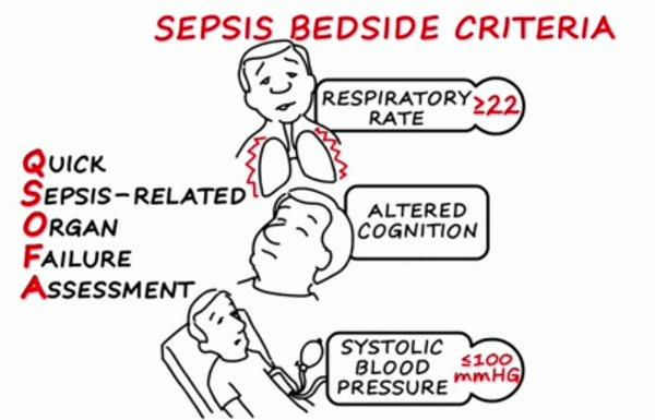 SEPSIS III klinická kritéria pro rychlé bed-side vyhodnocení orgánové dysfunkce mimo ICU Q-SOFA Přítomnost 2 nebo více qsofa