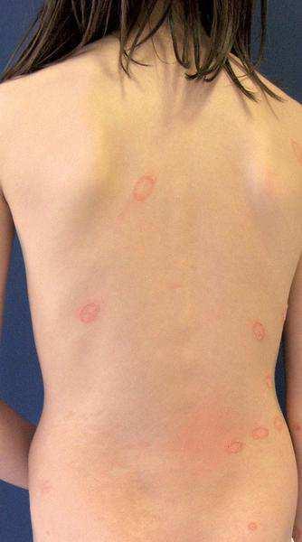 Dermatofytózy tinea corporis postihuje neochlupenou kůži trupu, paží až k zápěstí a dolních končetin, kromě třísel, chodidel a rukou typicky se projevuje jako okrouhlá olupující se ložiska, na okraji