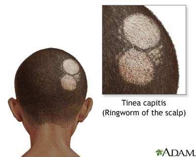 Dermatofytózy tinea capitis postižení vlasové části hlavy, obočí a řas typicky se tvoří ložiska s olámanými vlasy, kůže se loupe, případně se tvoří krusty v našich podmínkách nejčastěji vyvolané