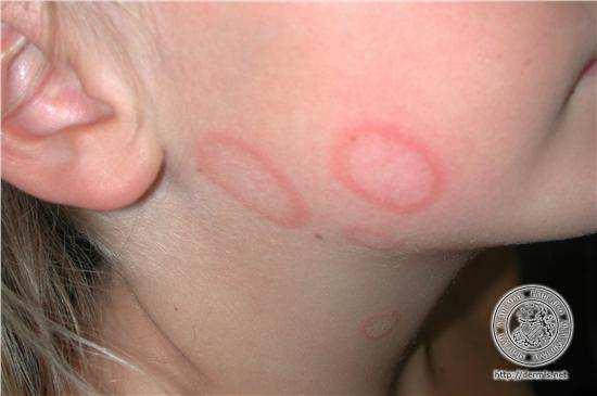 Dermatofytózy tinea faciei povrchní mykóza lokalizovaná v obličeji postihuje často děti začíná asymptomaticky, případně mírně svědí, proto