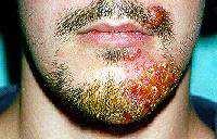 Dermatofytózy tinea barbae postižení vousaté části obličeje www.emedicine.