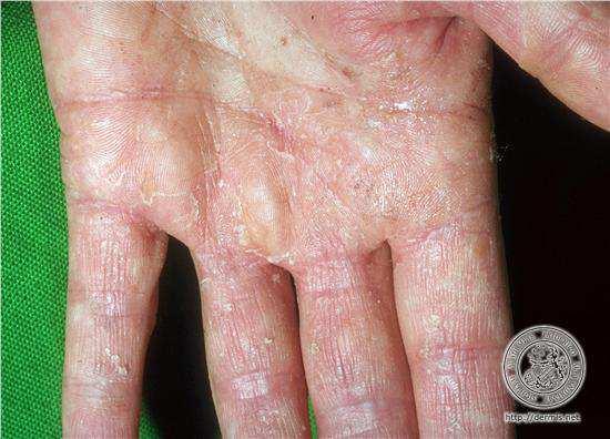 Dermatofytózy tinea manuum postižení dlaně nebo hřbetní části ruky méně častá dermatofytóza infekce antropofilním dermatofytem bývá na ruku přenesena sekundárně z mykózy nohou (Trichophyton