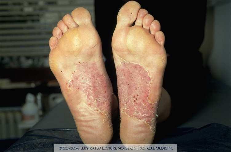 Dermatofytózy tinea pedis postižení plosky nohou - nemoc zvaná atletická noha nejčastější forma dermatofytické infekce postihuje meziprstní prostory nohou a plosky především mužů středního věku,