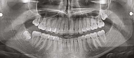 finální RTG snímek/figure 9A-B: Initial vs. final X-rays. Fotografie pacienta dodal Dr. Patrice Pellerin/Case photos provided by Dr. Patrice Pellerin. 3M, APC, Clarity, Forsus, MBT, and Victory Series are trademarks of 3M.