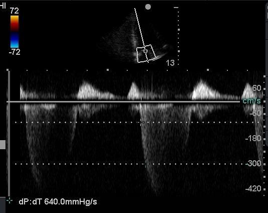 preloadem, ale ne afterloadem Přítomnost mitrální insuficience δp/δt > 1200 torr/sec normální