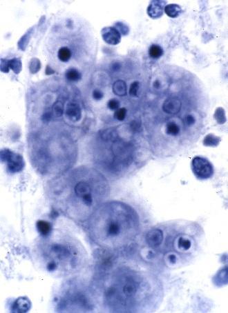 jpg Měňavka zubní(entamoeba gingivalis) Říše: Amoebozoa; Kmen Rhizopoda; Třída: Entamoebidea; Řád: Entamoebida; příklady příbuzných zástupců: Entamoeba dispar, Endolimax nana Měňavka zubní (viz Obr.