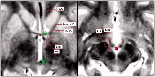 Implantační cíle OCD (+ MDD) Naesstrom, 2016 subcallosal gyrus (SCG), internal capsule (IC), the