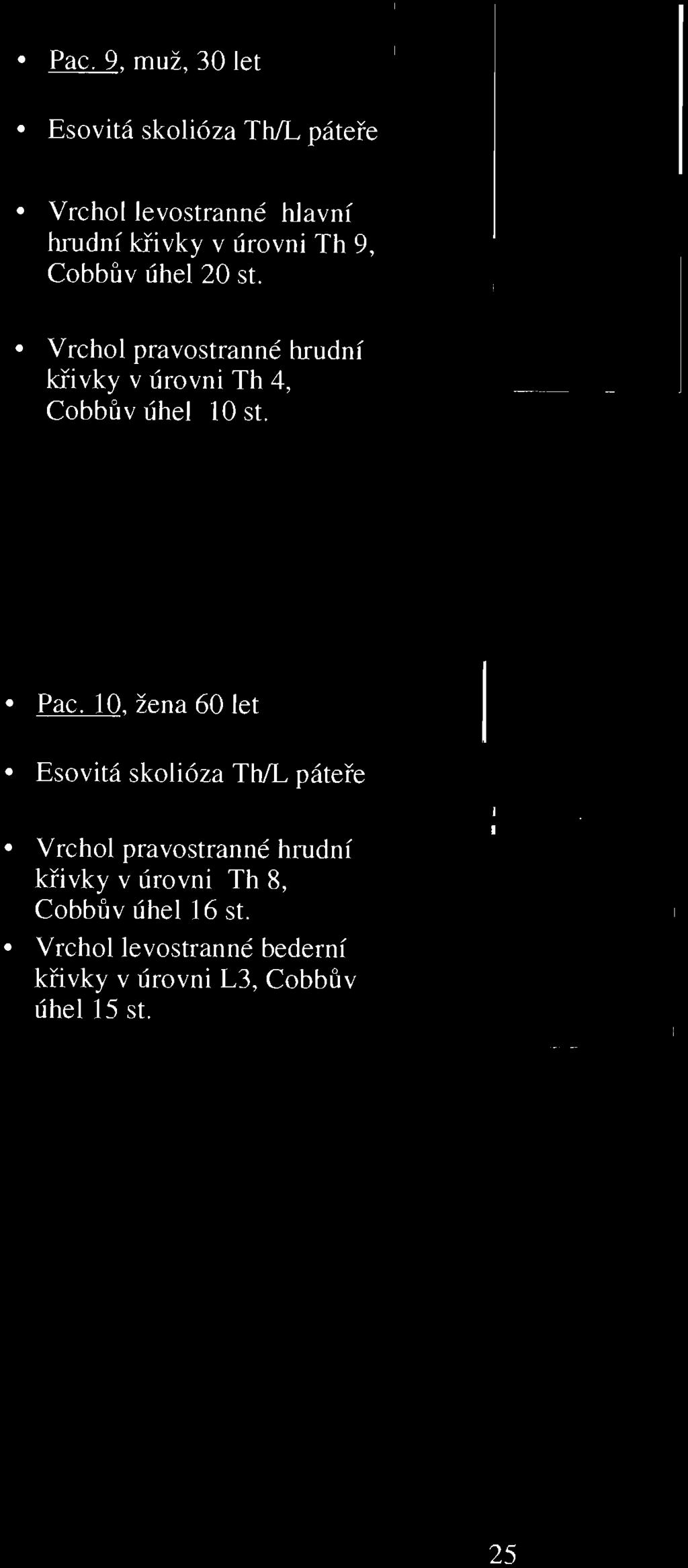 Vrchol pravostranné hrudní křivk y v úrovni Th 4, Cobbův úhel 10 st. Pac.