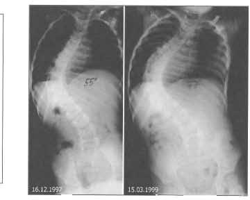 Progrese skoliózy u pac. 27 Progrese skoliózy z 55 st.