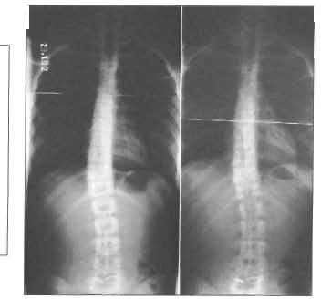 (snímek vpravo) Progrese skoliózy u pac 29 Progrese bederní