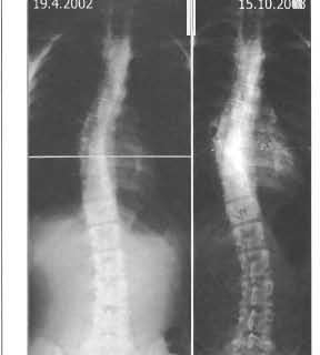 Progrese skoliózy u pac. 31 Progrese bederní křivky z 16 st.