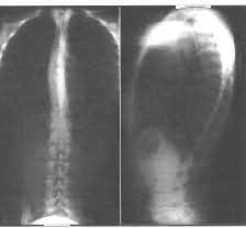 Tabulka 9.1. 9.10. Skupina 20 pacien tů s H MSN a deviací o.p. Elektromyografické nálezy. jehlová elektromyografie paraspinálních svalů Tab. 9.1. Rentgenový nález Elektromyografický nález Pac. 8, Š.