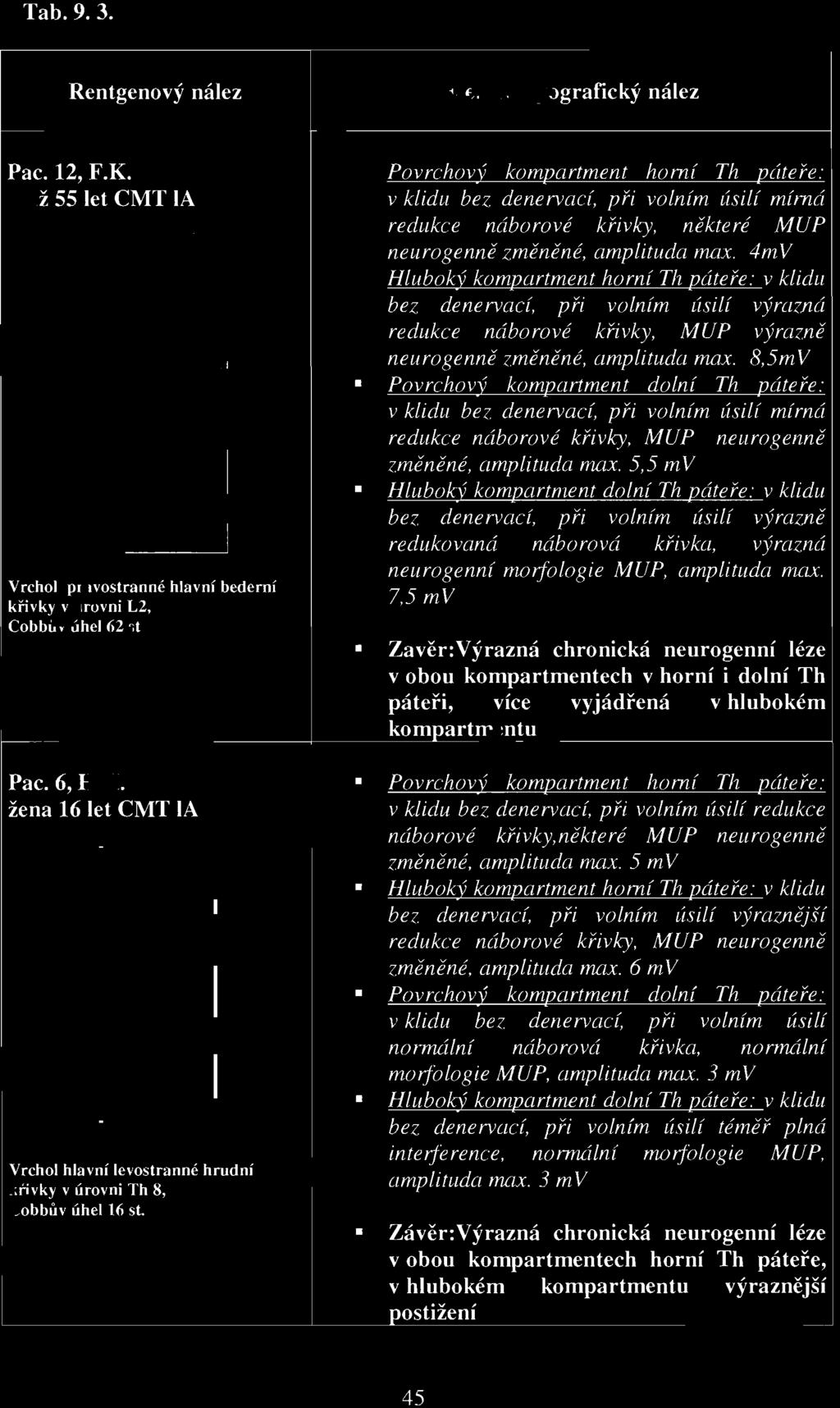 5,5 mv Hluboký kompartment dolní Th páteře: v klidu bez denervací, při volním úsilí výrazrzě redukovaná náborová křivka, výrazná neurogenní morfologie MUP, amplituda max.