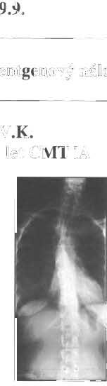 Tab. 9.9. Rentgenový nález Elektromyografický nález Pac. 7, V.K. žena 23 let CMT IA Vrchol pravostranné křivky hrud ní páteře v úrovni Th 5 Cobbův úhel 16 st.
