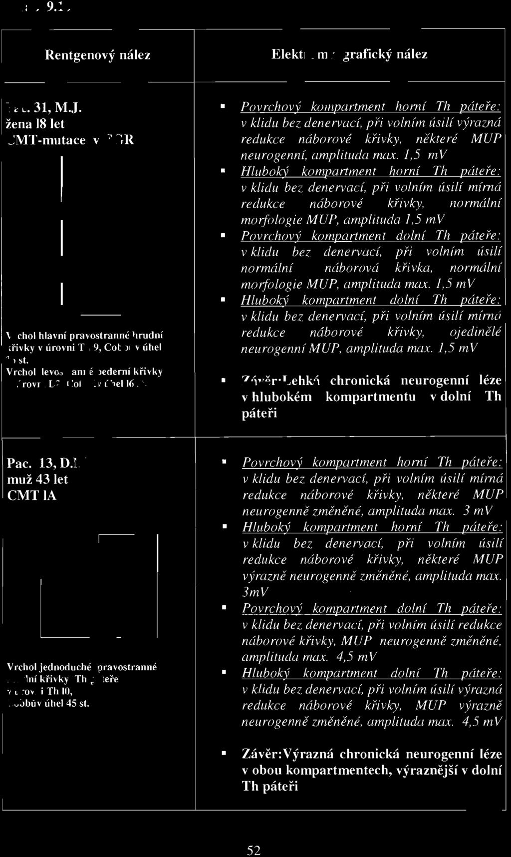 některé MUP neurogenní, amplituda max.