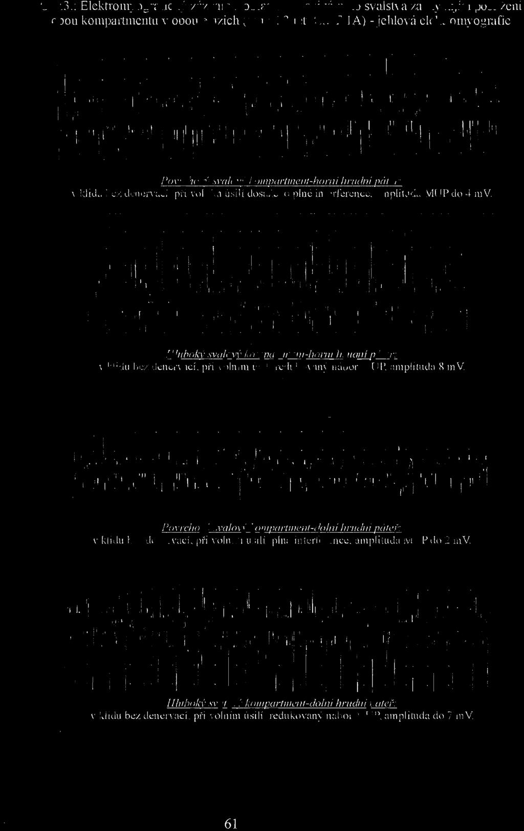 Obd,: E\cl~trolllyografi d,~ ' ZÚl.illl lll I. oblasti paraspilllillliho svalstva lachyclijici postižcni ObOll kompartlllclltll v obou etit/.ieh (Ill UL, 33 lel CMT J A) - jchloni elektromyografie j.