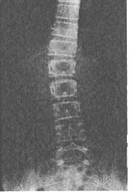 5 q -) 4 (:; 'kl 20 (25 ck l Z hlediska líže deformity jsme v rámci této podskupiny dife rencovali: skoliózu s Cobbovým úhlem hlavní křivky v rozmezi 10-20 st.