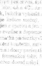 4A, B, ( Pí'i fotorpakci je zpomalená n;.ísledná mydriáza po ukonl" osl'il u, Slochosva lo\'á arei1exi e na všech končetinách, nevýl" né pyra midové Jf'vy spél stické, v,vrazna punč oc hovit.